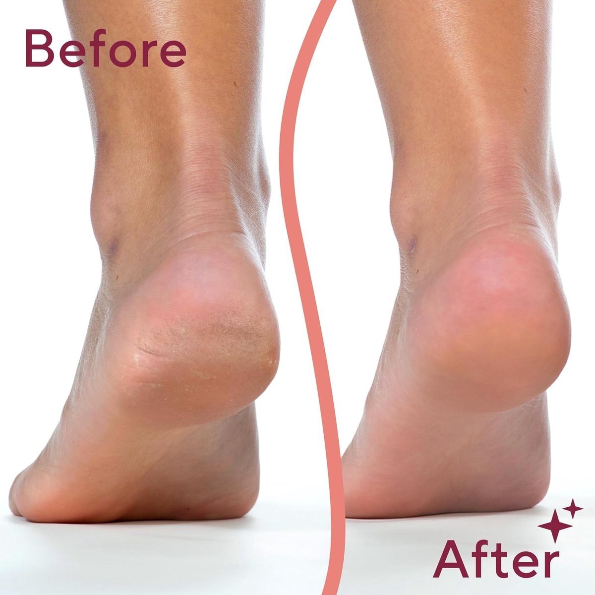 Foot Repair - Rechargeable Electric Callus Remover - Removes Dry Skin - For Smoother Feet