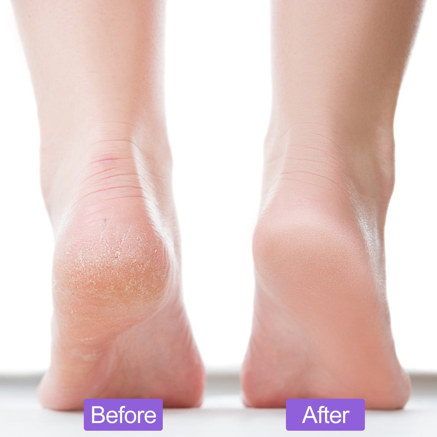 Clearance! PALIFEUR 2-Pack Foot Pumice Stone For Foot Callus Remover, Professional Pumice Stone for Feet Cracked Heel Dead Skin Remove 2 Sided Pedicure Tools Purple