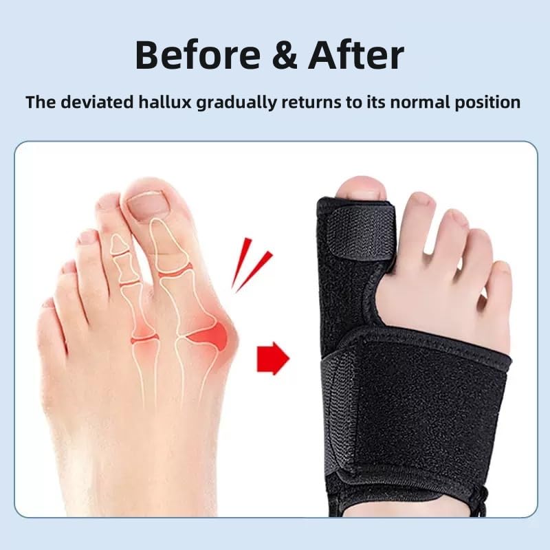 Recovist Bunion Brace - Adjustable Orthopedic Splint for Hallux Valgus Correction & Pain Relief, Day & Night Wear Support for Men & Women (2PC)